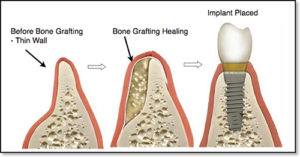 bonegraft