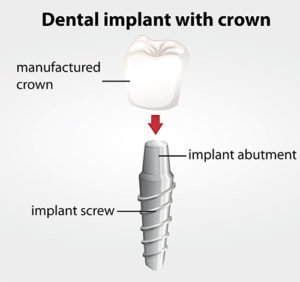 Dental implant with crown diagram Dental implant with crown diagram